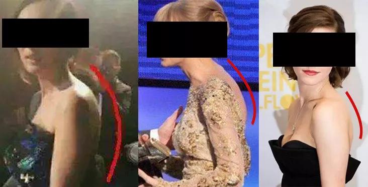 脖子前傾導致形體不佳，氣質大打折扣